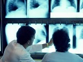 Researchers present scoring system for lung cancer screening