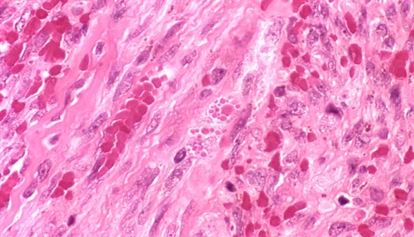 This micrograph depicts the histopathologic changes found in a biopsied lymph node indicative of a Kaposi sarcomatous lesion from a patient with AIDS. The histopathology revealed in this slide includes characteristic erythrocyte-filled, slit-like spaces, and occasional cells containing globules.