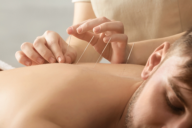 A young man being treated with acupuncture.