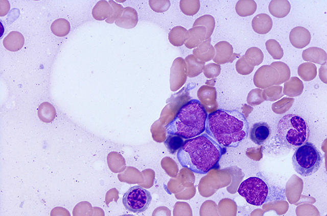 An enlarged view of AML.