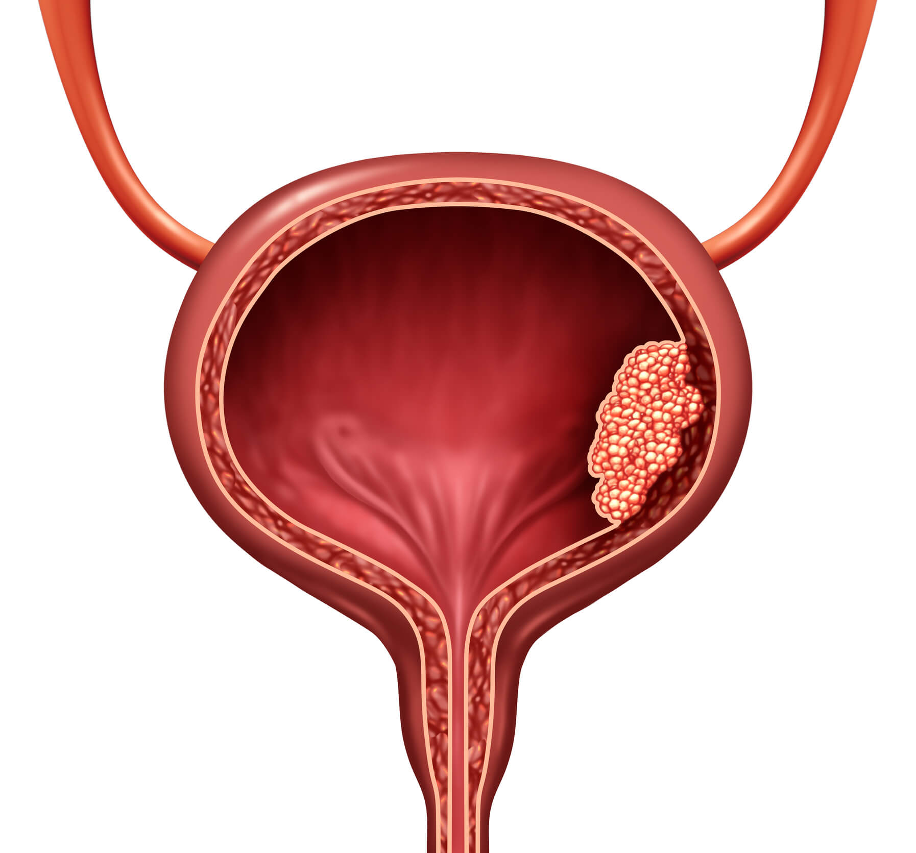 Bladder cancer illustration