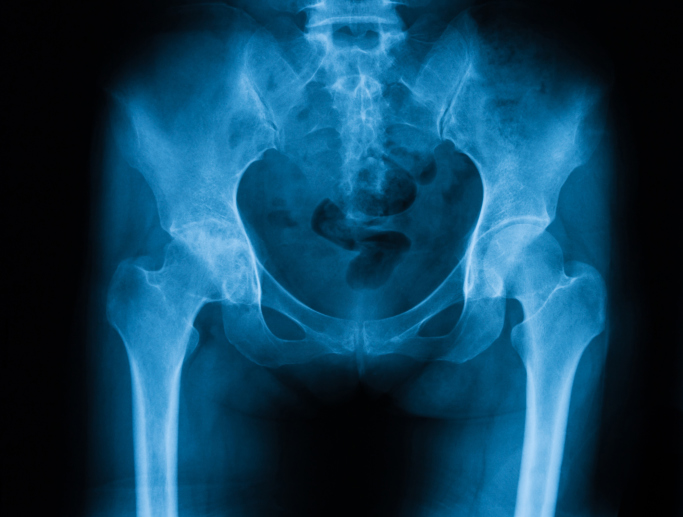 Incidence of vascular thromboembolic events in urothelial carcinoma treated with gemcitabine and car