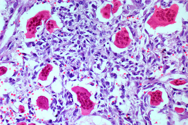 Bone tumour, light micrograph