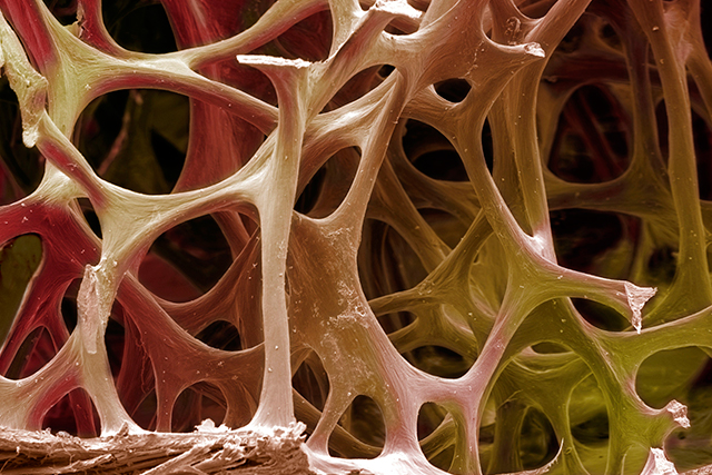 Coloured scanning electron micrograph (SEM) of cancellous (spongy) bone.