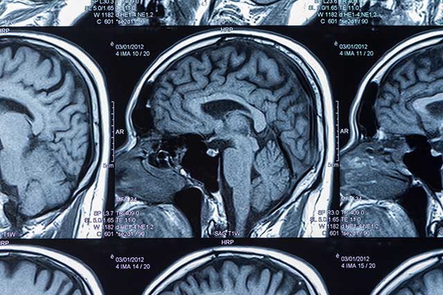 Brain MRI scan