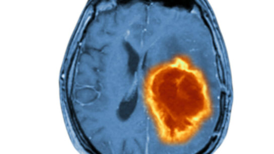 MRI showing metastatic brain tumor