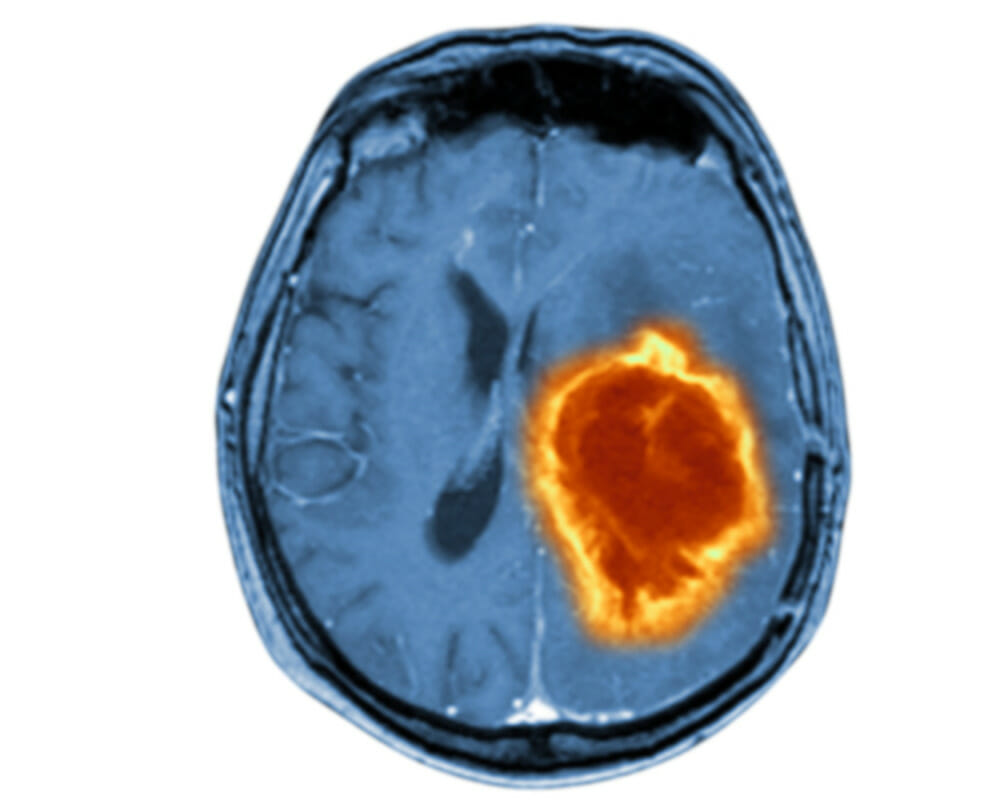 MRI showing metastatic brain tumor