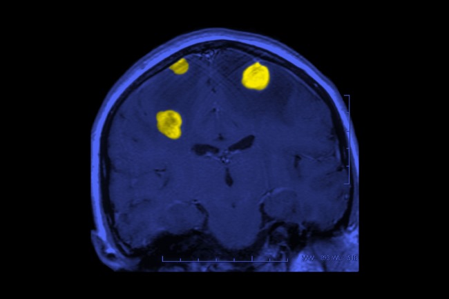 Updated results show prolonged responses to brain metastases.