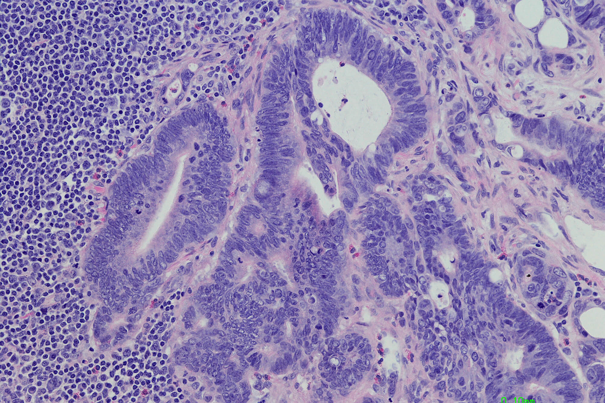 Lymph node with metastatic colonic adenocarcinoma