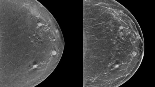 Digital breast tomosynthesis vs digital mammography
