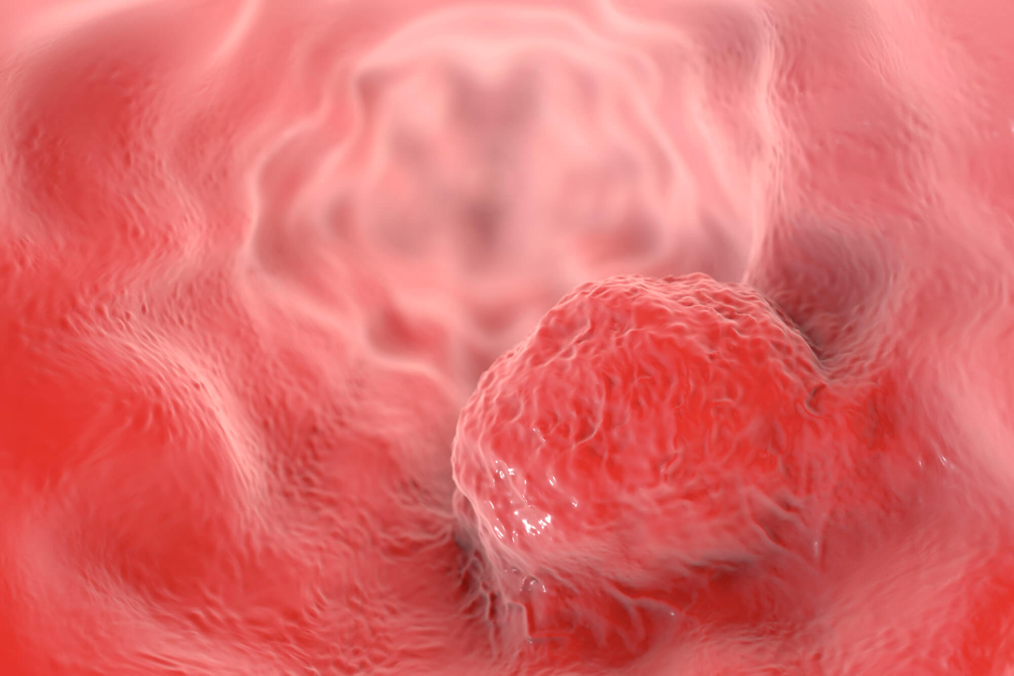 In this interim analysis, PFS rates were compared in PD-L1–defined biomarker subsets of patients receiving maintenance durvalumab or capecitabine.