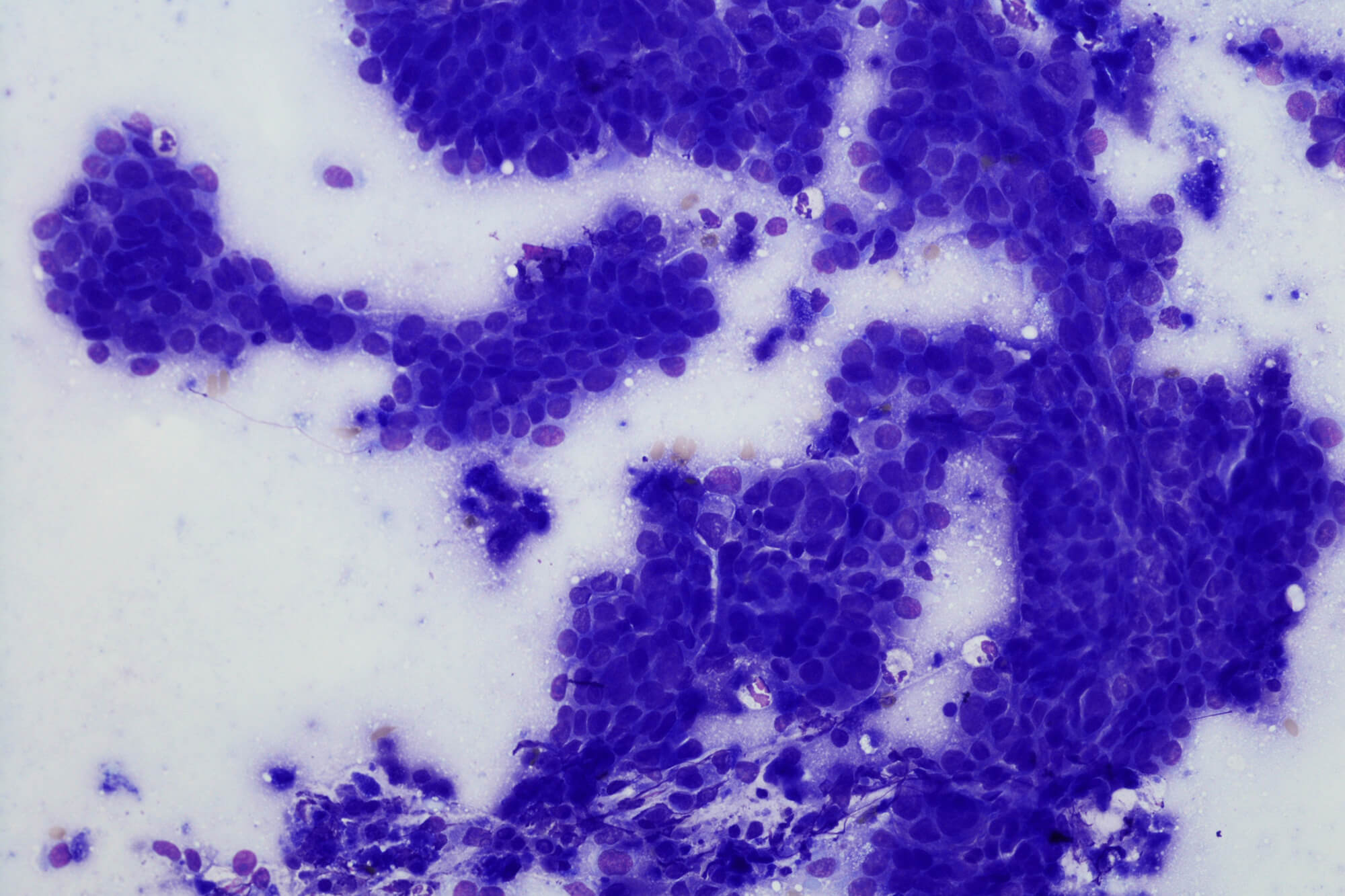 Cytology of esophageal adenocarcinoma.