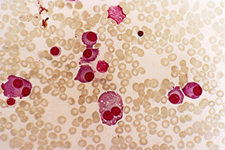 Multiple Myeloma