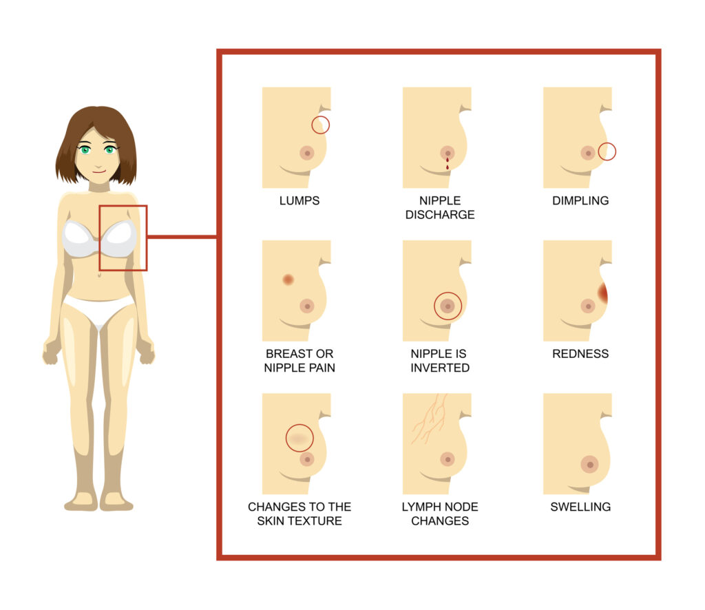 Breast cancer symptoms that may occur during the different stages of breast cancer.