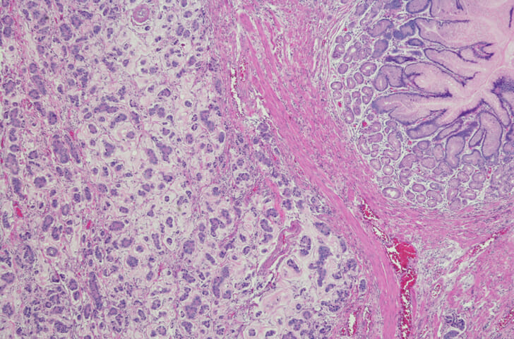 The diagnosis of linitis plastica, a subtype of gastric adenocarcinoma with a poor prognosis, can be