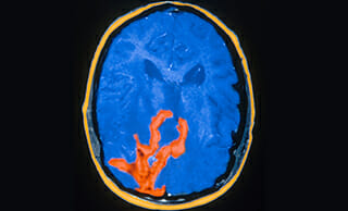 MRI of glioblastoma multiforme / Science Source