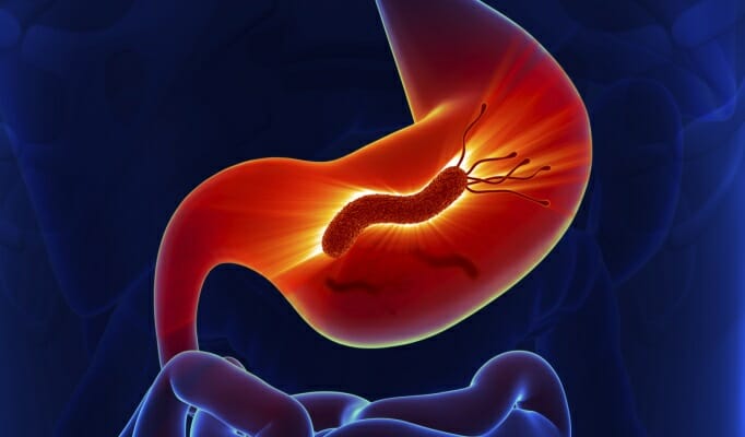 Gastric Cancer and the Link to Helicobacter Pylori Infection