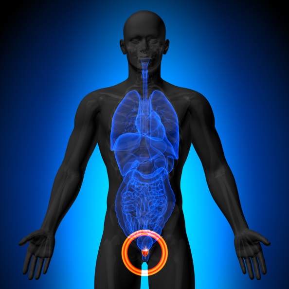 Hemiablation HIFU for Prostate Cancer