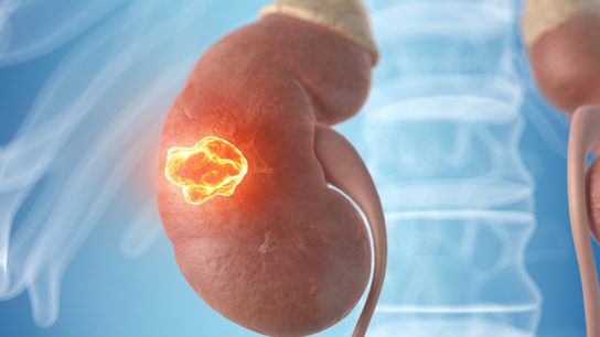 kidney cancer tumor illustration