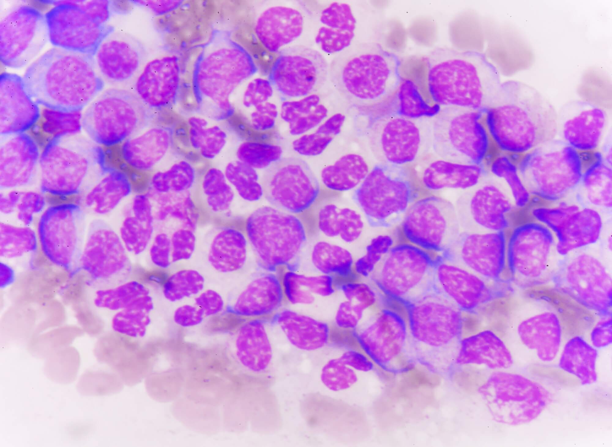 Leukemia blast cells