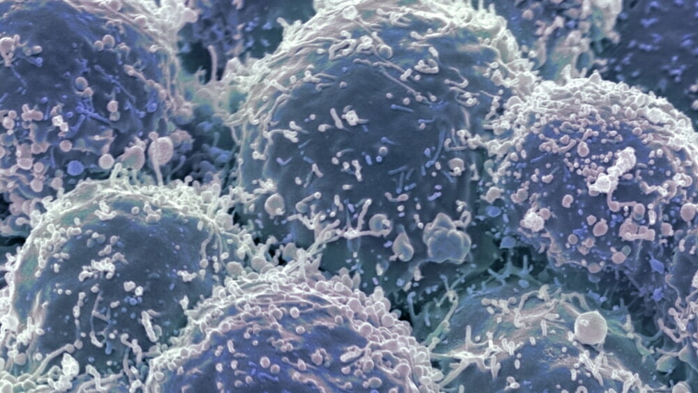 Lung cancer cells