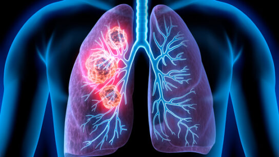 Lung cancer