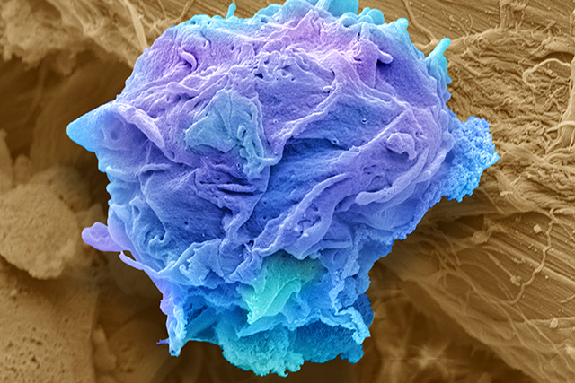 Colored scanning electron micrograph (SEM) of a lymphoma cell.