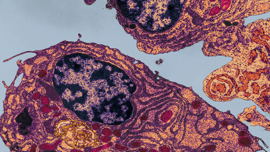 Patterns of Cadiotoxicity Associated With Carfilzomib