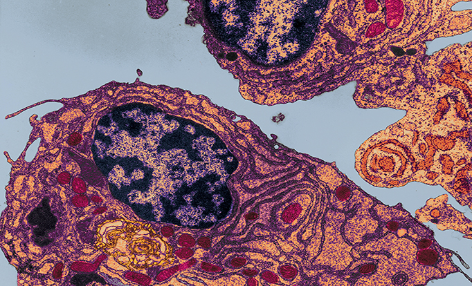 Patterns of Cadiotoxicity Associated With Carfilzomib