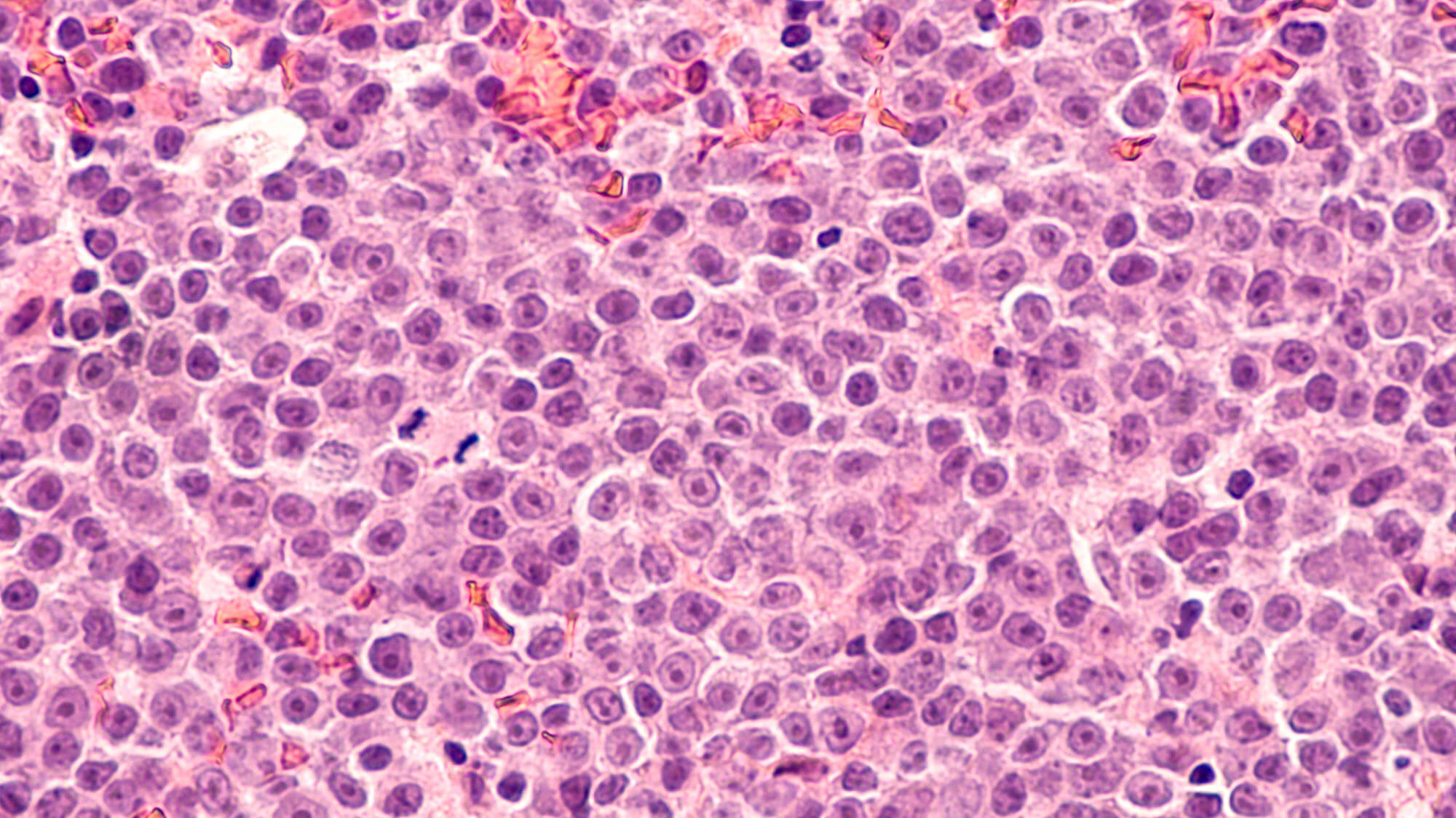 Myeloma