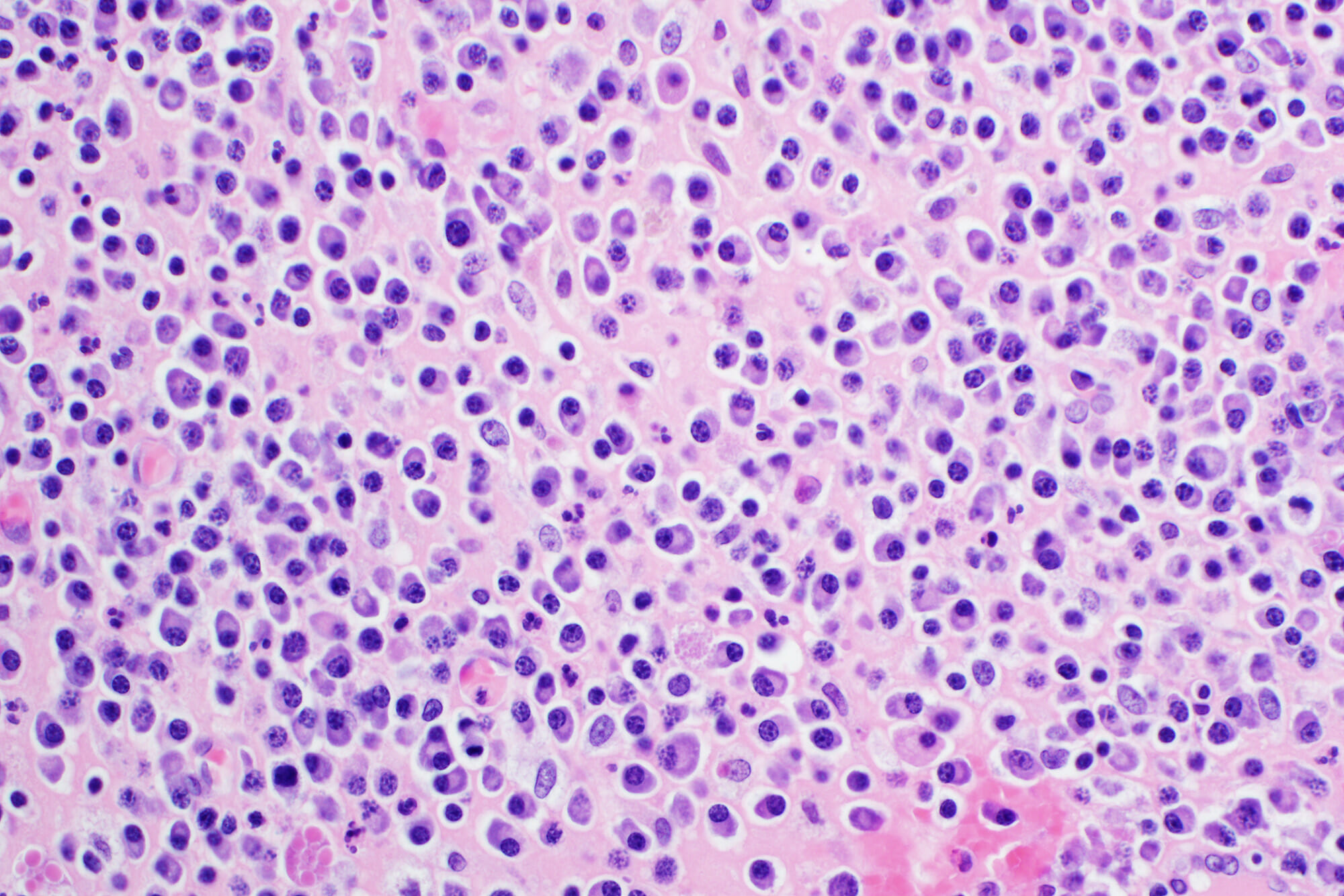 Light microscopy, multiple myeloma.