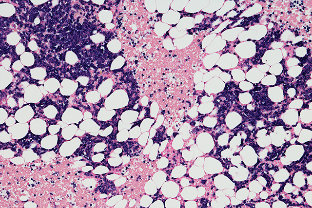 Micrograph of myeloma neoplasm.