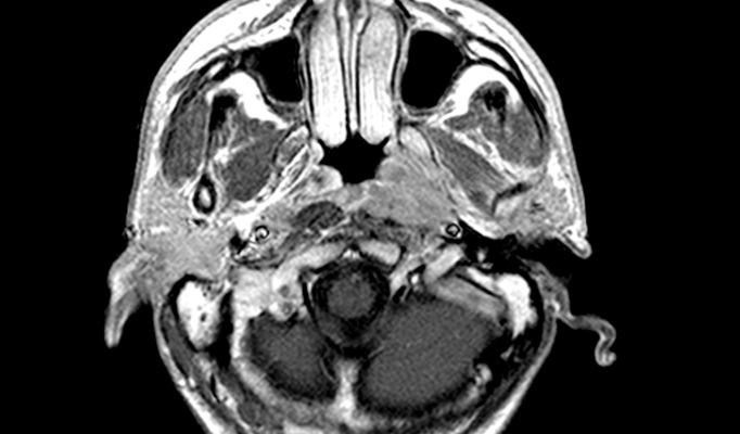 No Benefits from Neoadjuvant Gemcitabine + Carboplatin + Paclitaxel in Nasopharyngeal Cancer