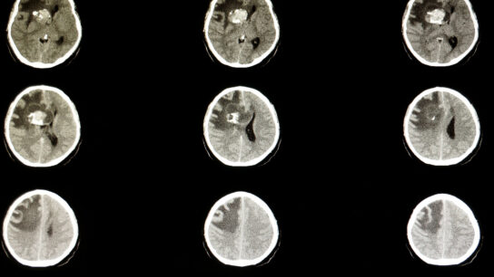 CT scan of a brain anaplastic oligodendroglioma