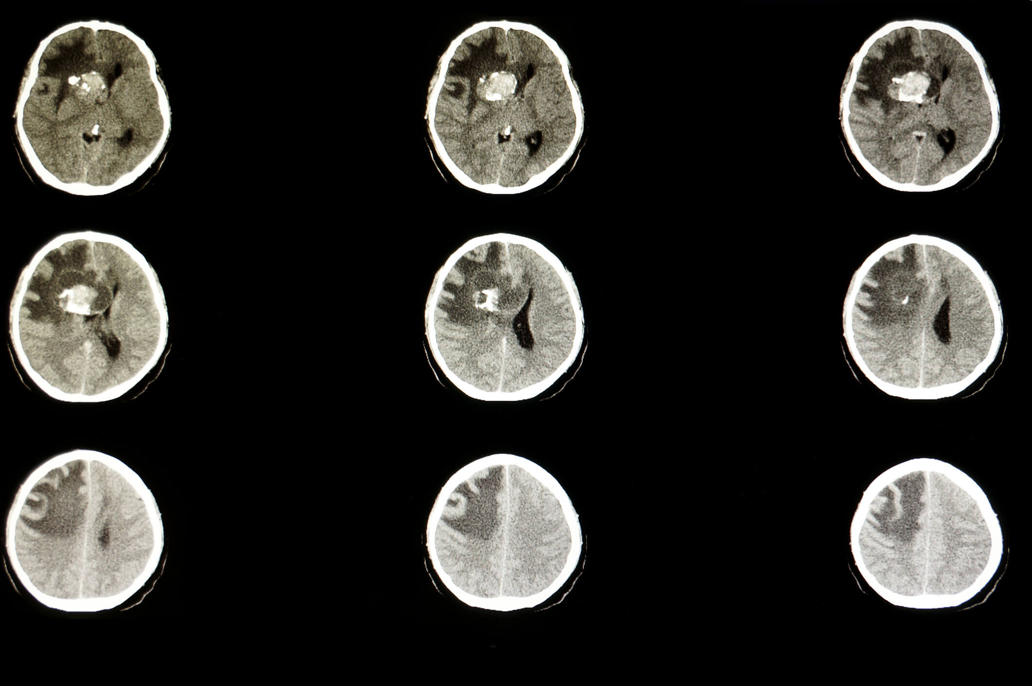 CT scan of a brain anaplastic oligodendroglioma