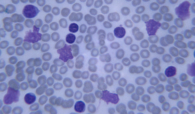 acute lymphoblastic leukemia