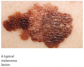 Melanoma associated with indoor tanning