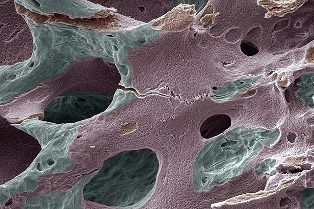 Scanning electron micrograph of human bone, osteoporosis