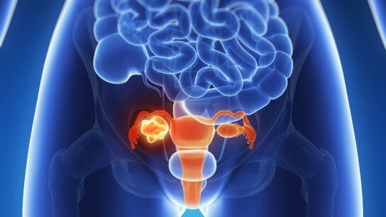 Ovarian cancer