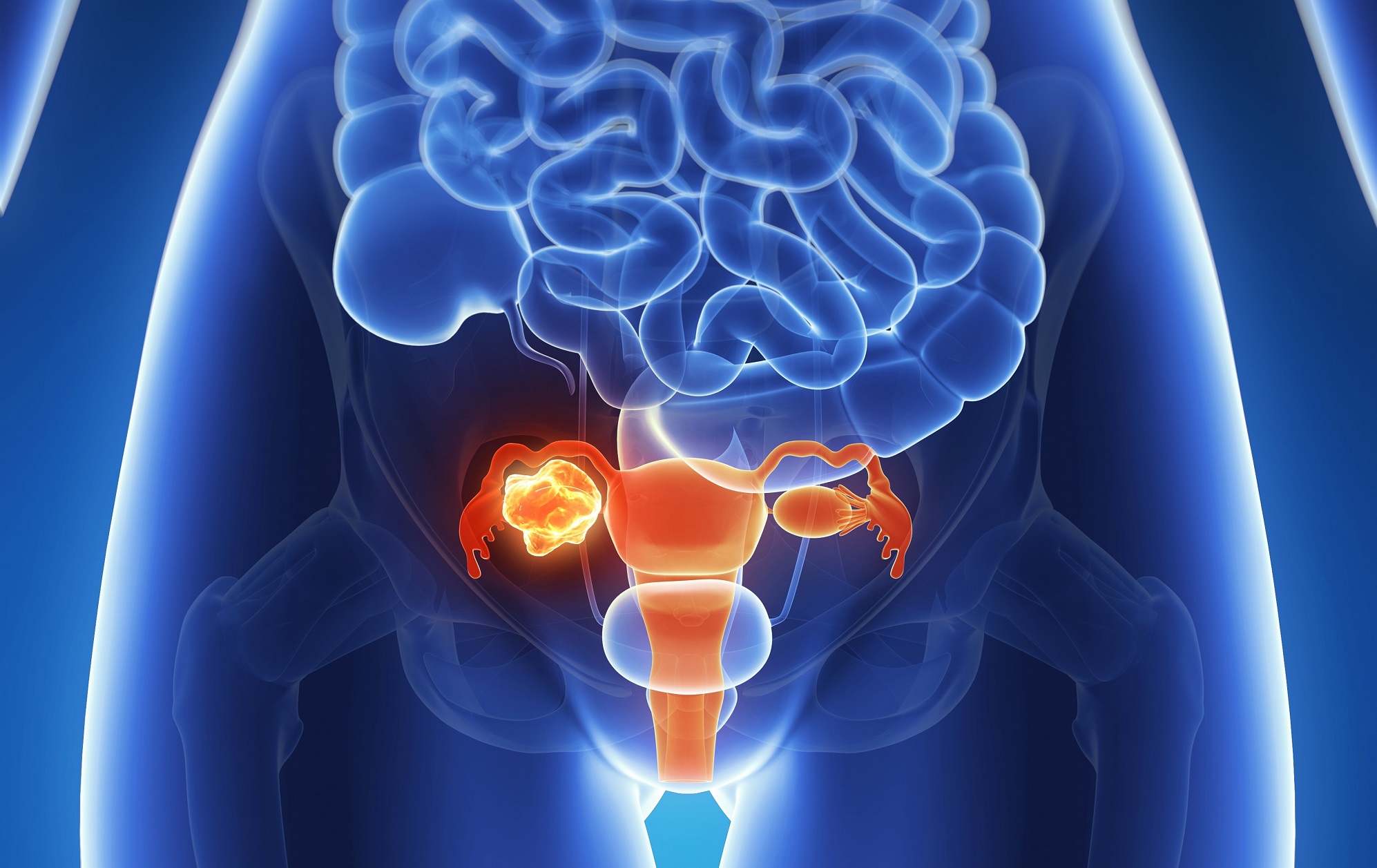 Ovarian cancer