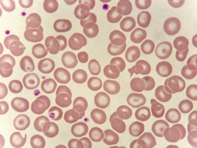 A blood smear of chronic myeloid leukemia cells.