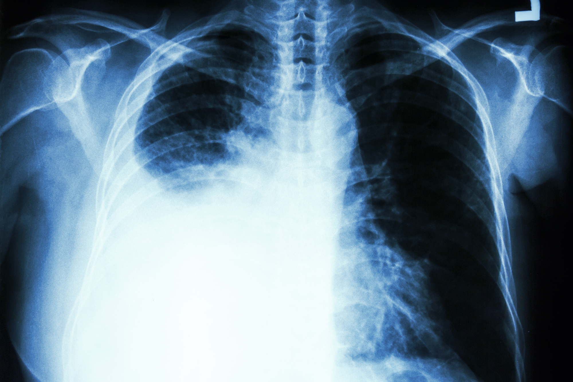 Pleural effusion caused by lung cancer.