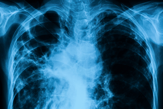 Pneumonitis