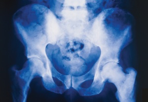 Bone Metastases