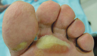 Prevention and management of hand-foot syndromes