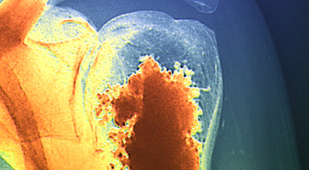 Guidelines reflect changes in radiotherapy for bone metastases