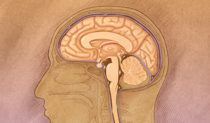 Neoplastic meningitis: Keeping palliative care options open