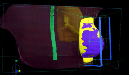 New guidelines from ASTRO for whole breast irradiation