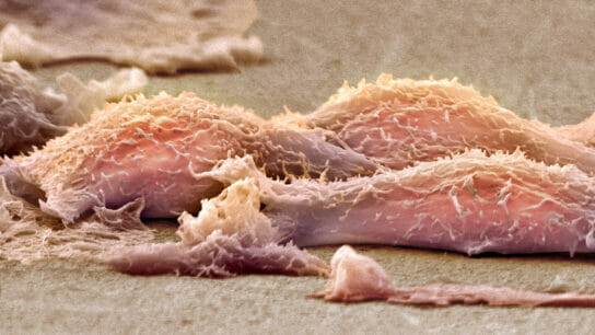 Sarcoma cells