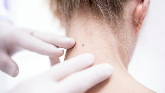 A recent study documents a downward trend in melanoma incidence in adolescents and young adults, but experts disagree about the causes.